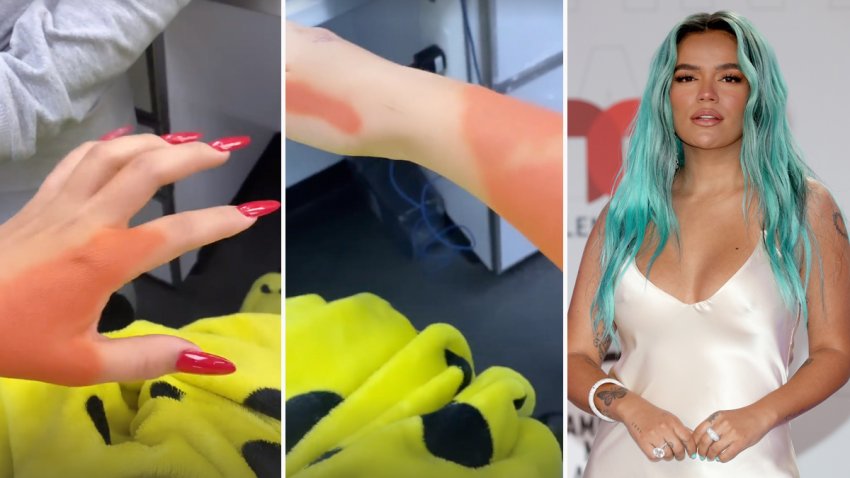 Ahora fue su turno: Karol G se quitó los tatuajes de Anuel AA