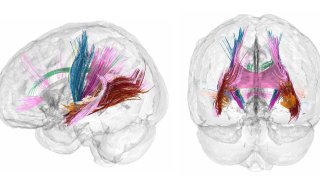 El cerebro de la mujer disminuye de tamaño durante el embarazo