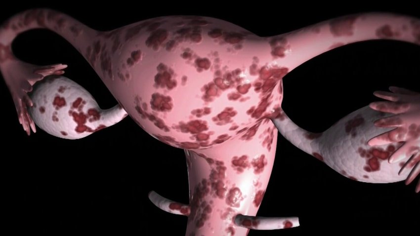 Qué es y cómo se trata la endometriosis